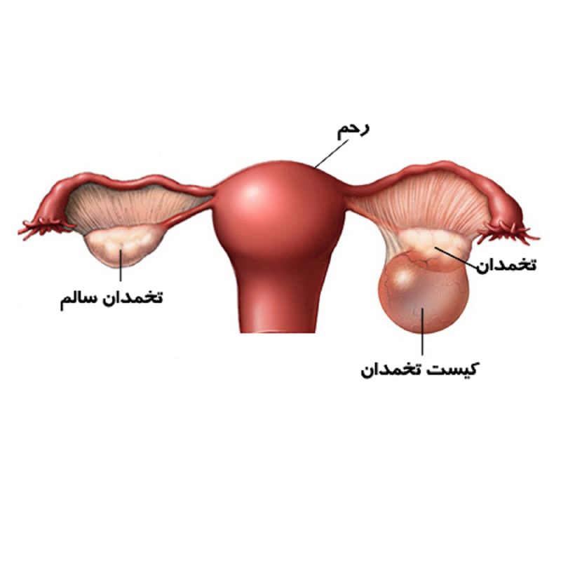 اطلاعاتی که باید در مورد کیست تخمدان بدانید